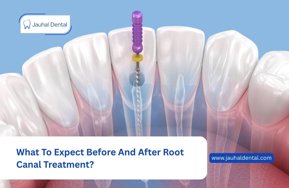 What To Expect Before and After Root Canal Treatment