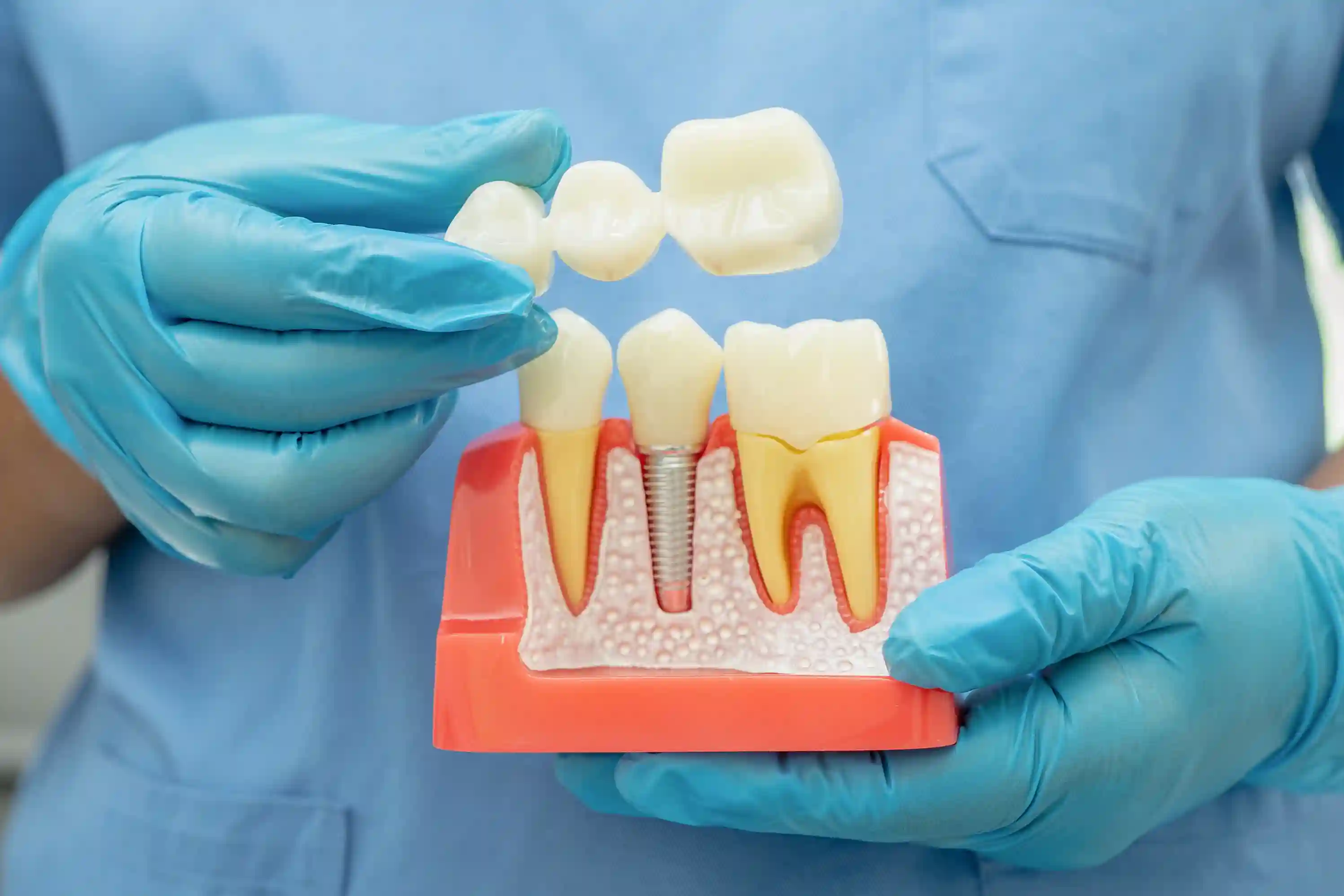 dental-implant