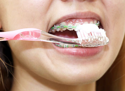 How to Clean Around Braces