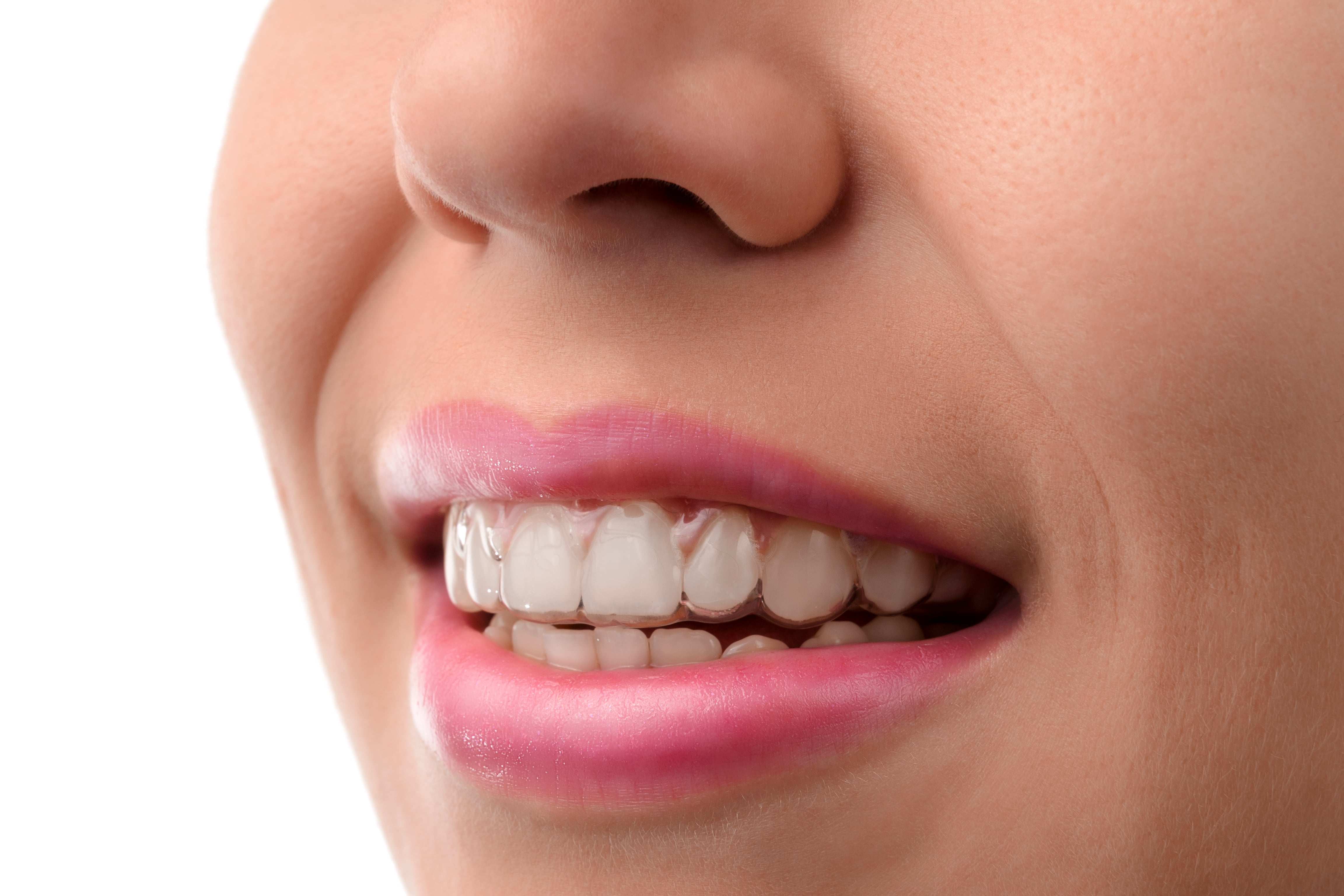 Cosmetic dental treatments: straighten your teeth with nearly invisible braces