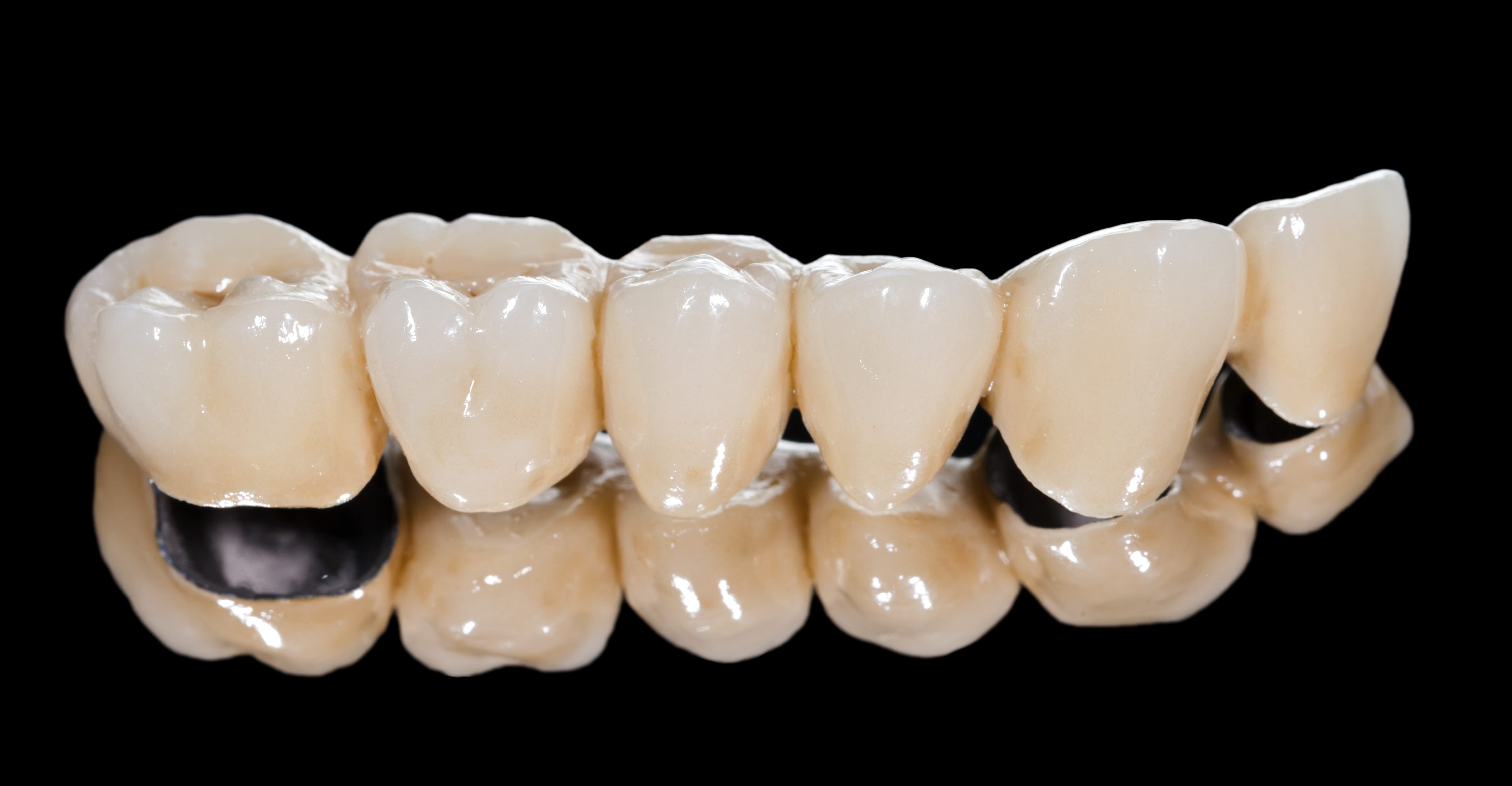 What are Dental crowns and Tooth Bridges?