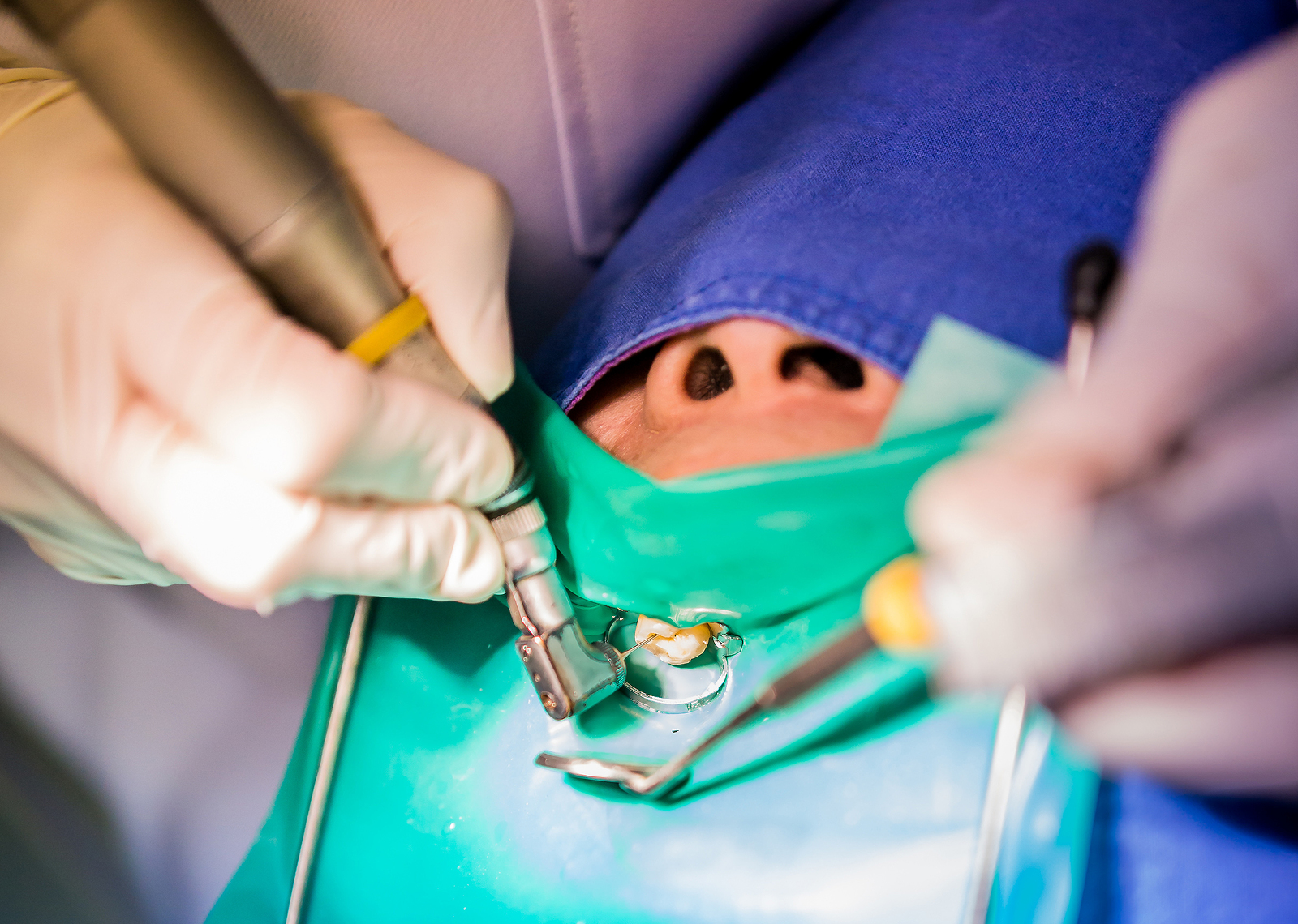 All you need to know about root canal treatment