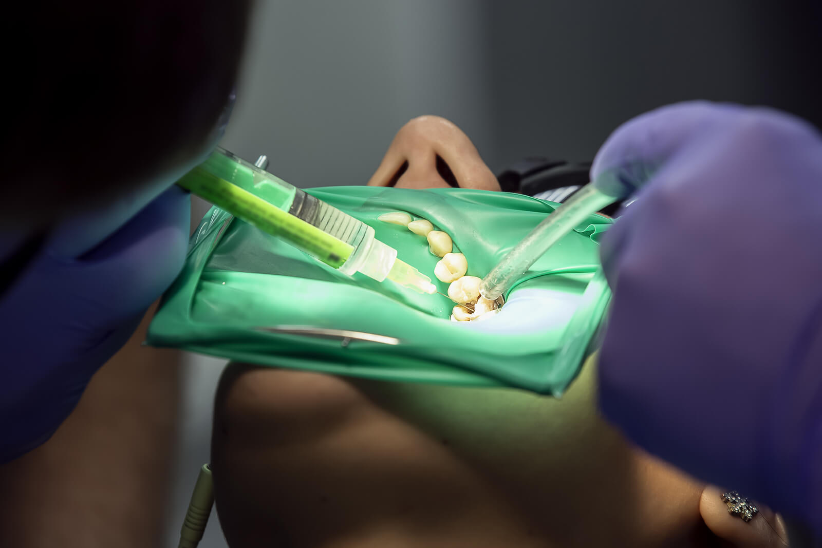 Signs that you need root canal treatment