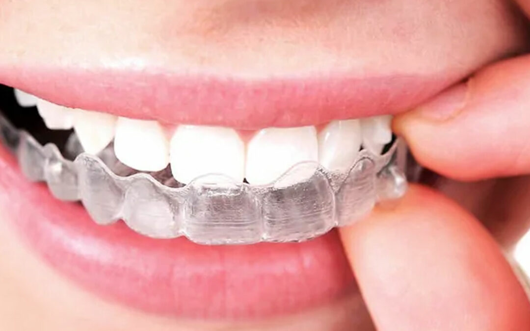 Understanding the Cost of Invisalign in Mississauga: A Comprehensive Guide by Jauhal Dental